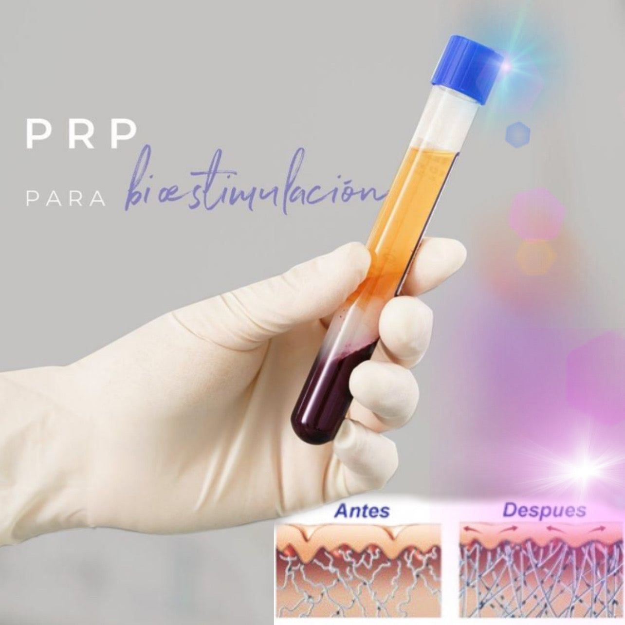 Plasma Rico en Plaquetas